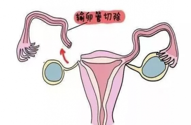 青海慈铭博鳌国际医院三代试管婴儿，切除双侧输卵管还能做试管婴儿吗？